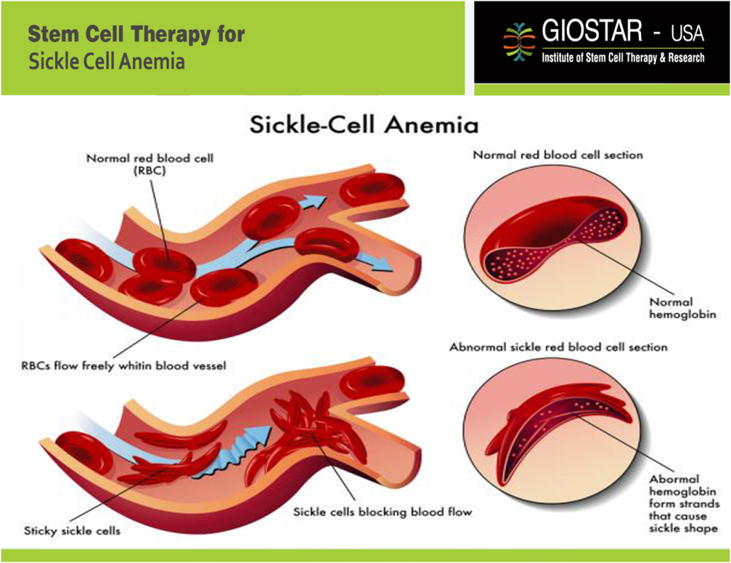 Sickle Cell Anemia Treatment Giostar