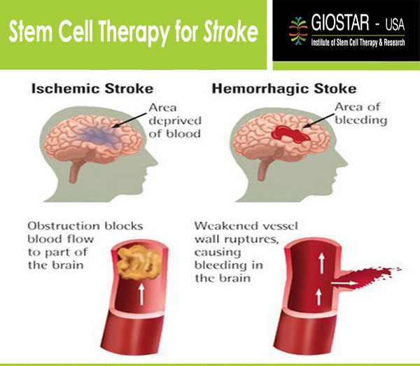 Stroke Treatment