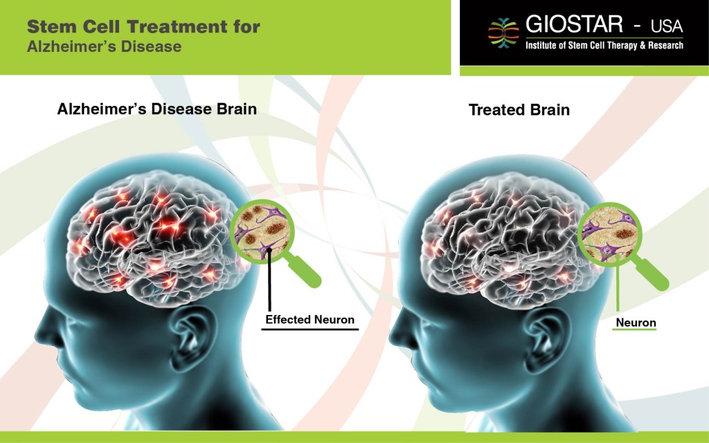 Stem Cell Treatment for Alzheimer's