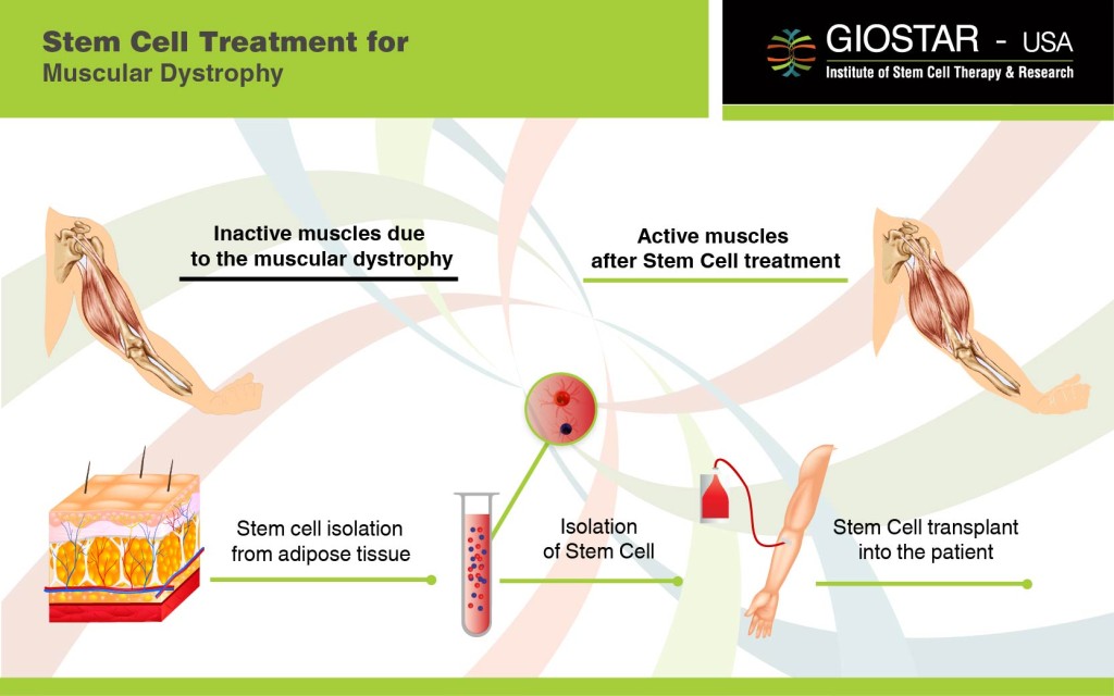 Stem Cell Treatment for Muscular Dystrophy
