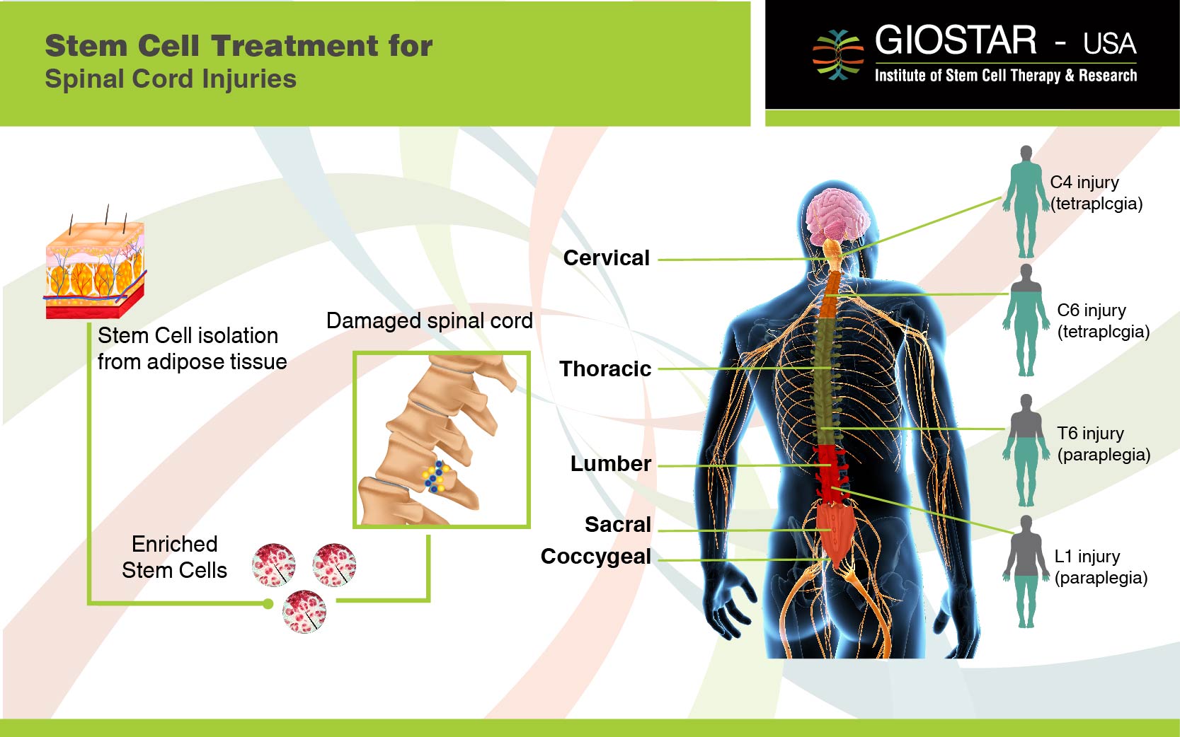 Stem Cell Treatment for Spinal Cord Injuries