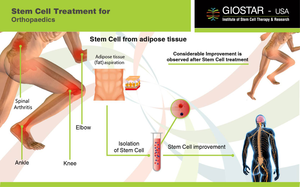 Stem Cell Treatment for Orthopedics