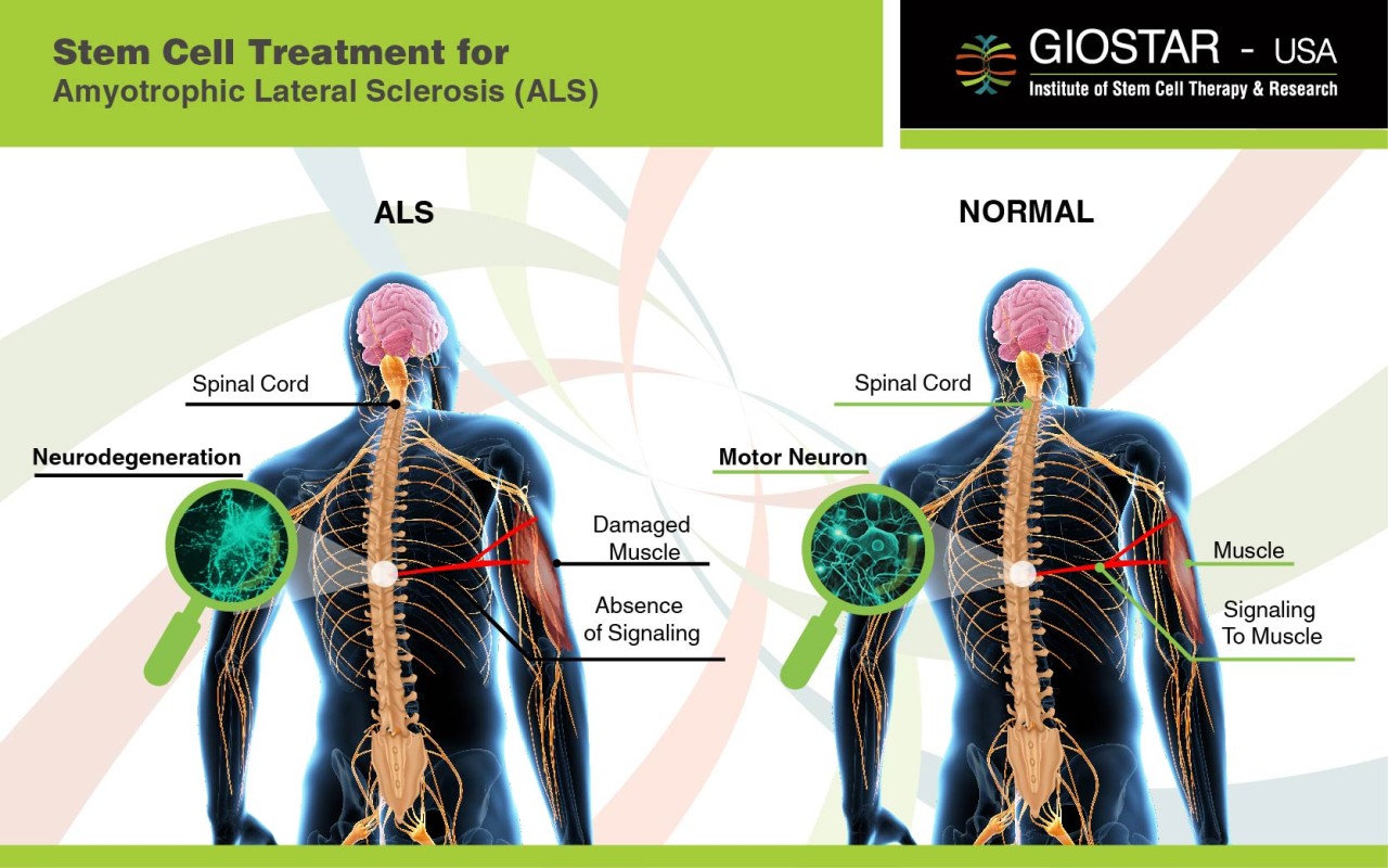 Stem Cell Therapy for ALS, Treatment for ALS in India