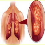 Lung Cancer Treatment in India